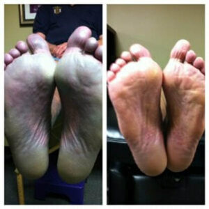 neuropathy-results-in-atlanta-orig